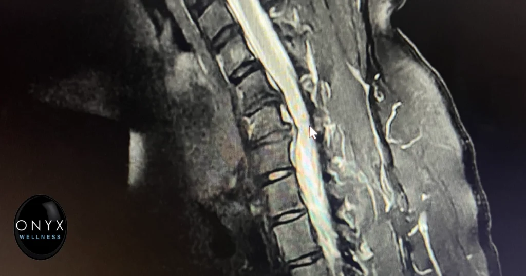 MRI scan showing herniated discs at C6 and C7 vertebrae in cervical spine