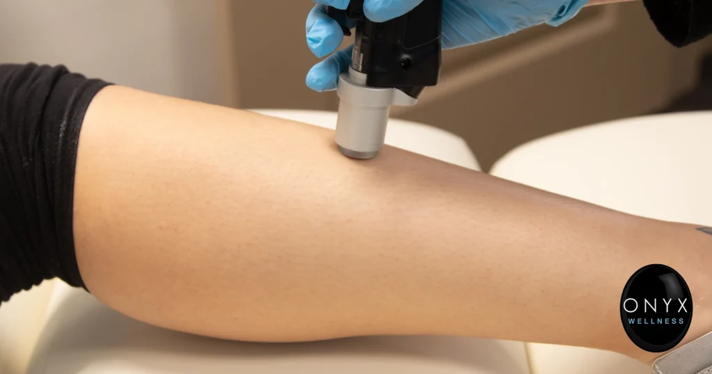 Close-up of a laser hair removal treatment being performed on a patient's lower leg by a provider wearing blue gloves. A handheld laser device is applied to the skin in a clinical setting.