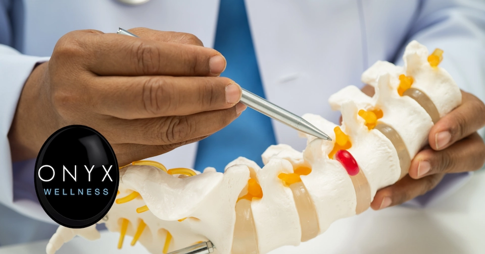 doctor using a pen to point to a model of a herniated spinal disc
